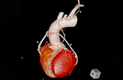 冠動脈バイパス術後の3DCT画像