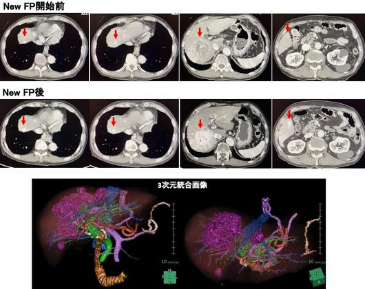 最大腫瘍径5cm以上で多発する肝細胞がんの症例